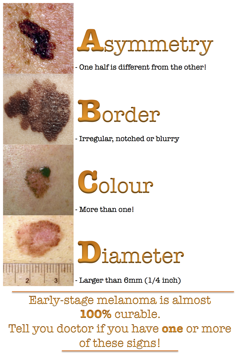 Mole Chart For Skin Cancer