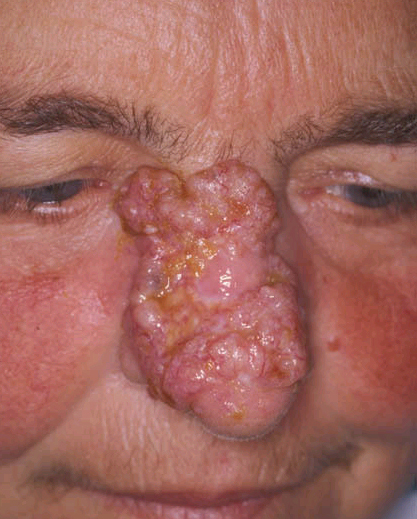 nose cancers pictures #10